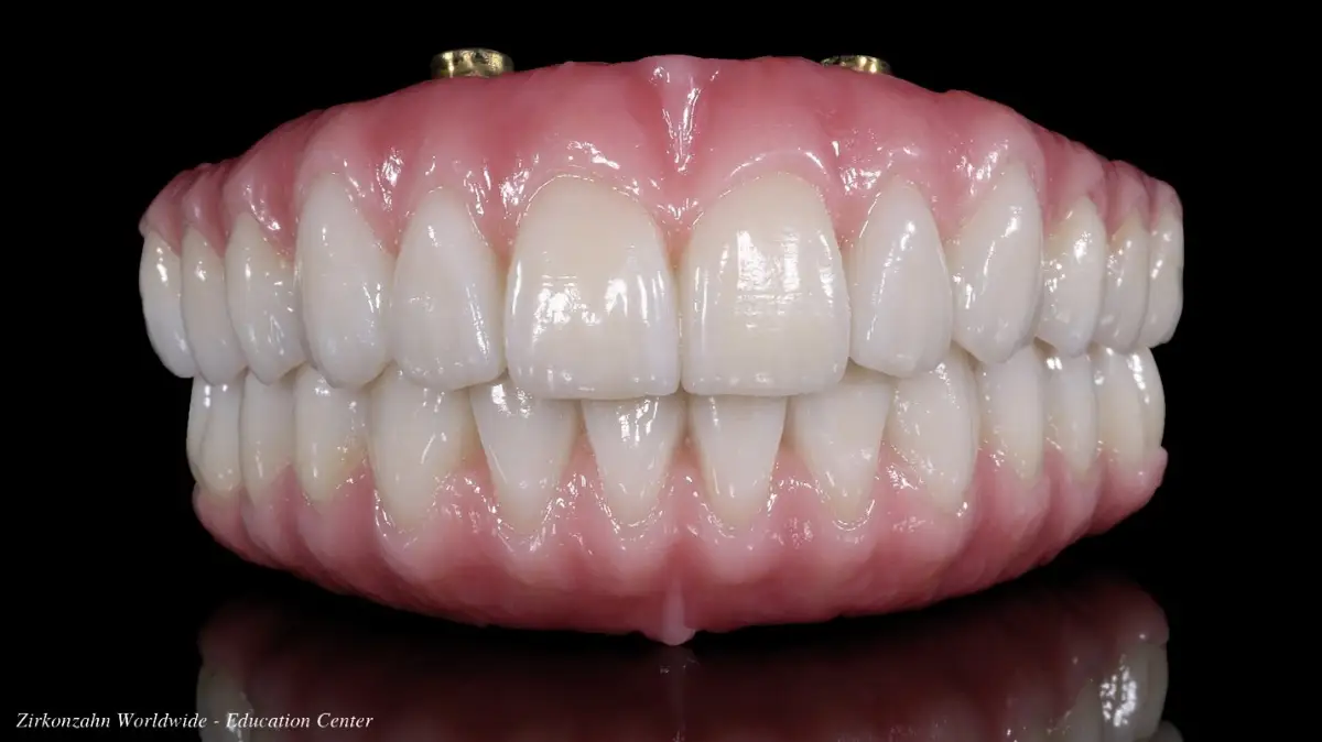 Precision-crafted full-arch prosthesis from our in-house lab