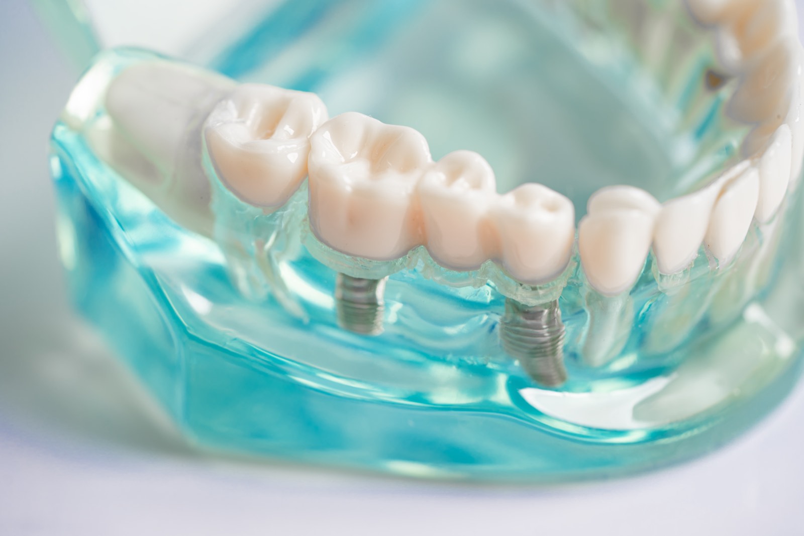 Dental model showing implant posts supporting a fixed bridge